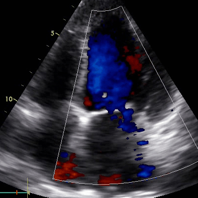 Ecografia doppler a arterelor renale